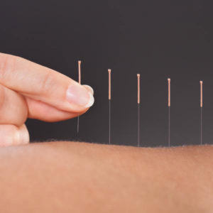 Dry-Needling